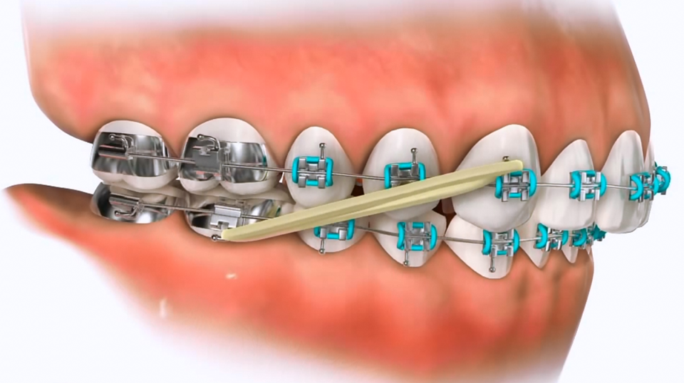 class II elastics